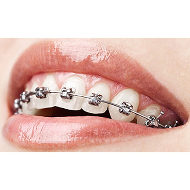 Metal Braces, Mack Orthodontics